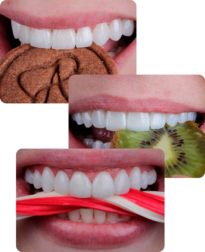 Facetas em resina com acabamento natural e brilho